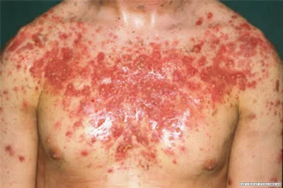 La salud de la piel y la alimentación. Como prevenir el acné, las arrugas, la psoriasis y el daño inducido por la radioterapia