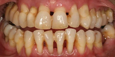 Encía con enfermedad periodontal o periodontitis