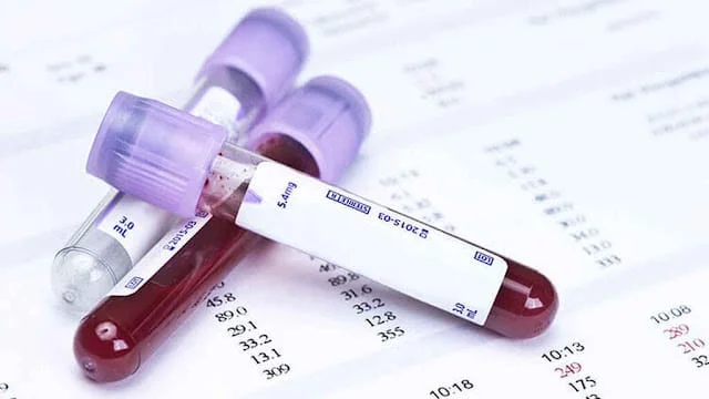 Tubos de análisis de sangre en laboratorio para revisar vitamina D, insulina, ferritina y proteína C reactiva