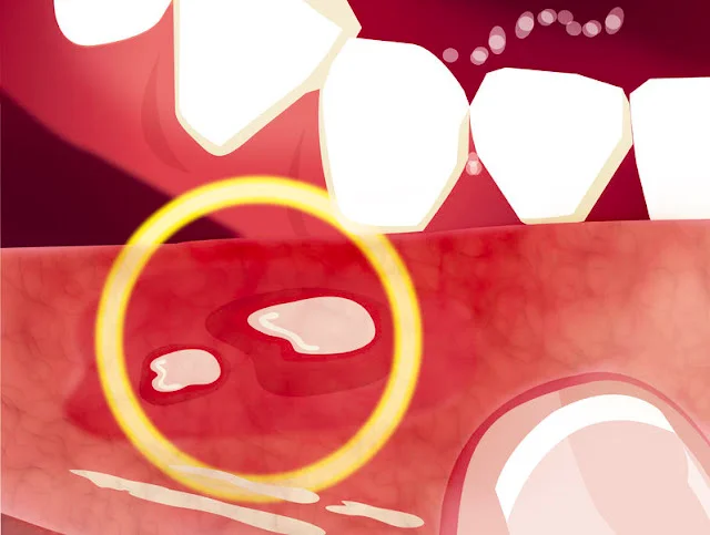 Mujer con dolor en la boca por mucositis asociada al tratamiento del cáncer