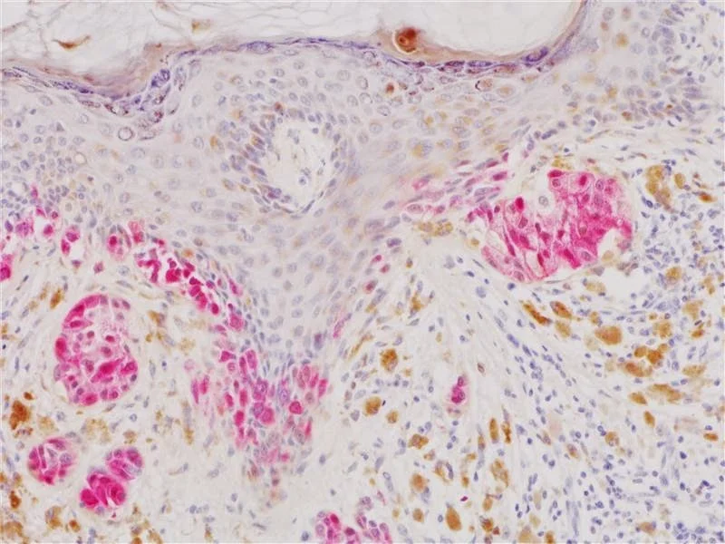 Inmunoterapia: detener el cáncer en vez de aniquilarlo