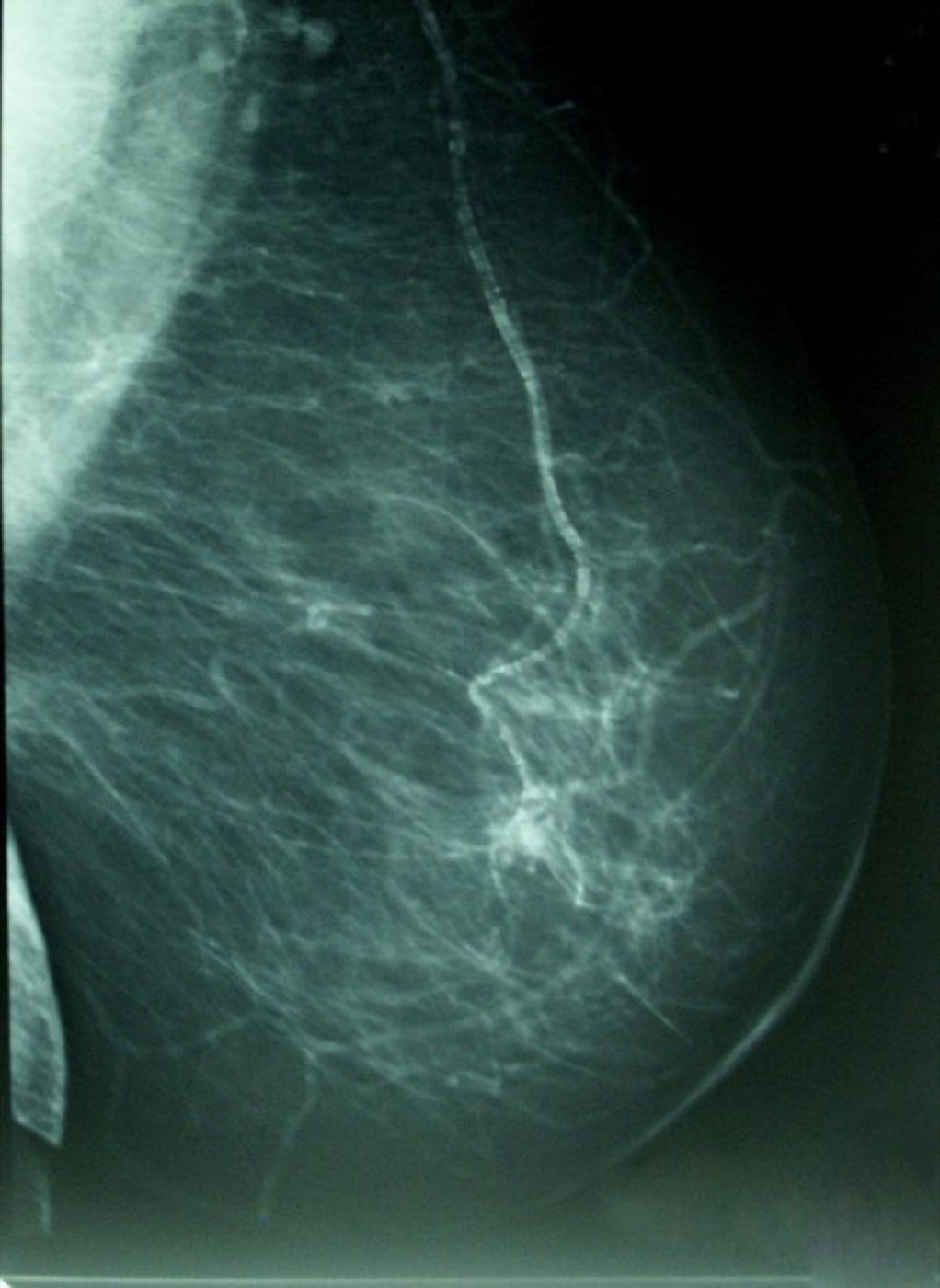 El estrés puede favorecer la metástasis del cáncer de mama