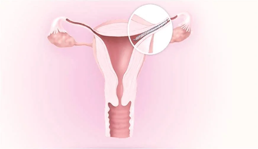Dispositivo anticonceptivo Essure, un pequeño muelle metálico que se implanta en las trompas